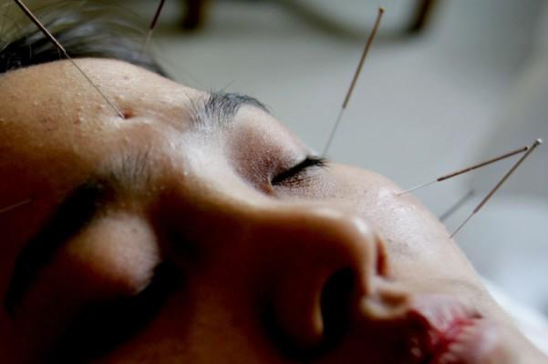 Vid akupunktur används tunna nålar för att återställa balansen mellan yin och yang. (Foto: China Photos/Getty Images)