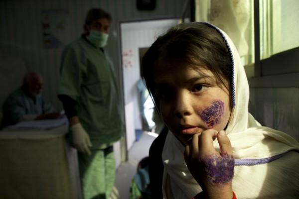 14-åriga Shafiqa väntar på behandling på en gratisklinik för behandling av leishmaniasis, stödd av Världshälsoorganisationen. Bilden tagen i Kabul, Afghanistan, i oktober 2010. (Foto: Paula Bronstein/Getty Images)