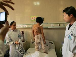 Elvaåriga Ren Xin från den svårt förorenade Shanxiprovinsen undersöks innan hon ska opereras. Ingreppet innebär att ta bort en tredje hand som växer ut från hennes rygg. Enligt rapporter har antalet kinesiska barn som föds med defekter ökat med sex procent varje år och andelen barn med handikapp är upp emot 40 procent. Många oroar sig för att siffrorna är relaterade till miljöförstöringen. (China Photos/Getty Images)