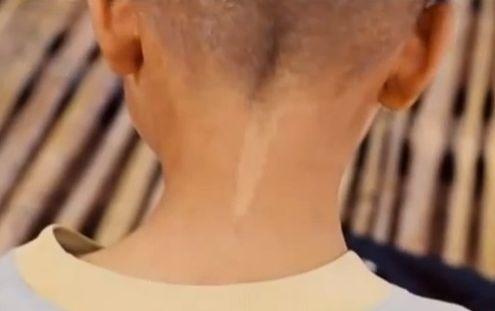 En pojke i Thailand med ett födelsemärke i nacken som liknar ett märke som gjordes på hans mormors nacke innan hon dog och kort före hans födelse. (Skärmdump/YouTube)
