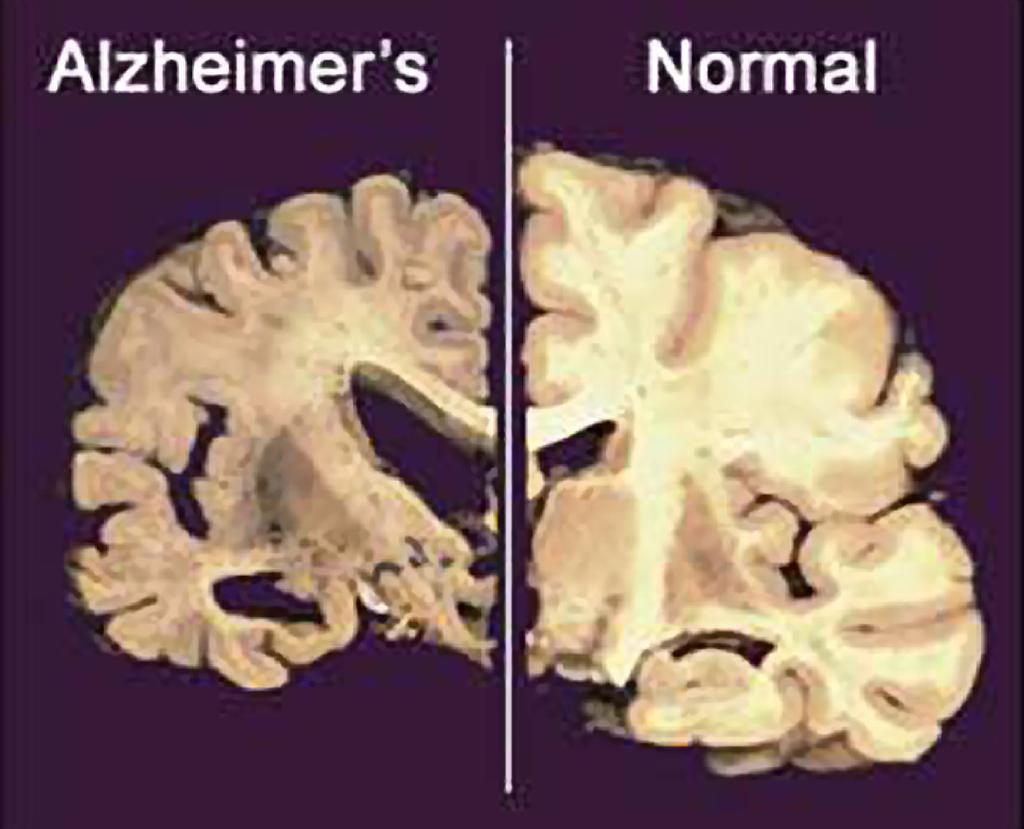 
Så småningom leder Alzheimers sjukdom till att hjärnan bryts ner. (Foto: AP/TT)