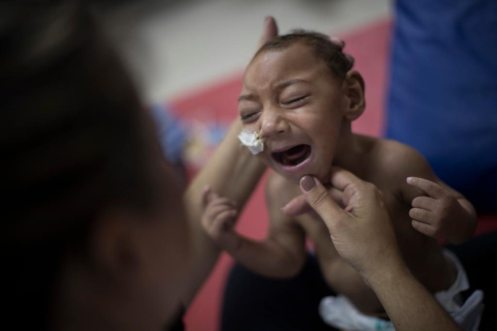 
En ettårig pojke i Brasilien som föddes med mikrocefali. Mikrocefali innebär att barnet föds med för litet huvud och hjärna. (Foto: Felipe Dana/AP/TT-arkivbild)