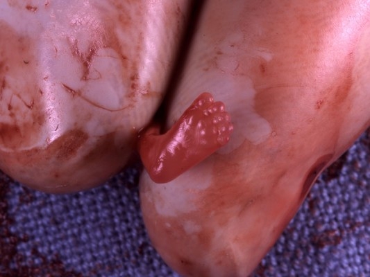 Ett aborterat foster, åtta veckor efter befruktningen. Det motsvarar ofta graviditetsvecka tio, då graviditetsvecka utgår från menstruationens första dag. (Foto: MRO)