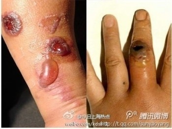 Bybor från Ganmazhen i Lianyungang, Jiangsuprovinsen, har smittats av mjältbrand från en infekterad ko. Byn stängdes av och smittade personer isolerades i ett närliggande sjukhus. (Weibo.com)