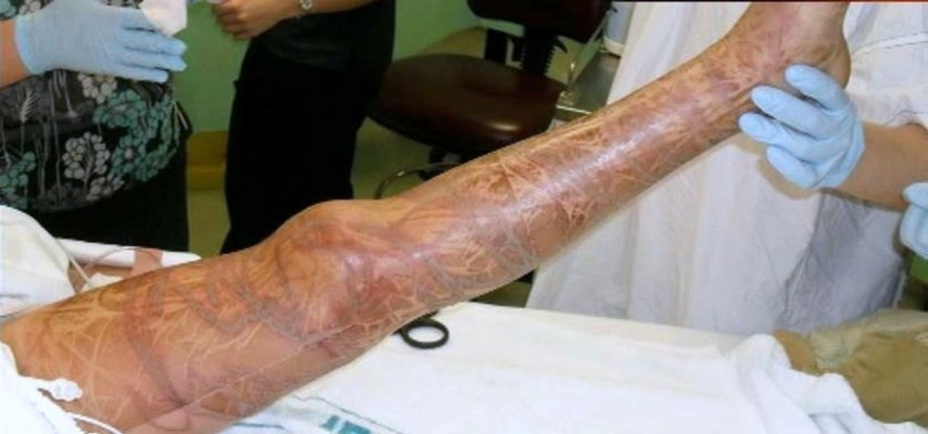 Otäck bild: sådana här brännmärken kan man få om man kommer i kontakt med en farlig manets tentakler, något som den 59-åriga kvinnan inte hade några märken av. (Foto: AFP)