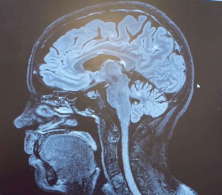 Vita fläckar indikerar var sjukdomen ms har skadat personens hjärnvävnad. På bilder av någon med diagnosen schizofreni har förändringar inte påträffats. Foto: Privat