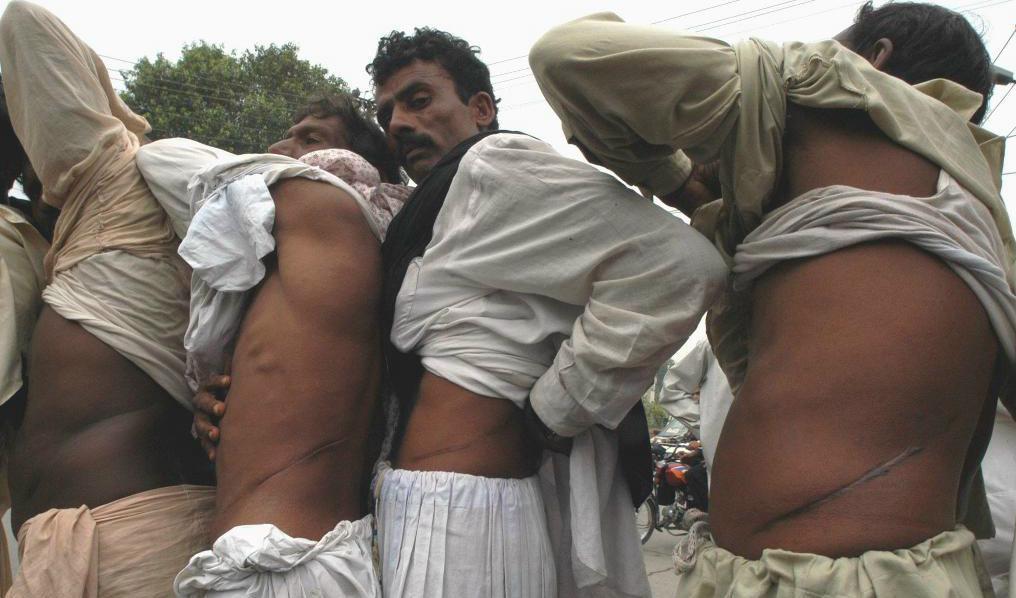 


Säljare av njurar visar upp sina ärr i Lahore. Foto: K M Chaudary/AP/TT-arkivbild                                                                                                                                    