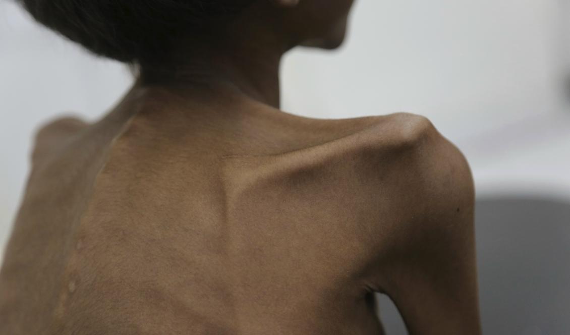Femåriga Mohannad Ali sitter på en sjukhussäng i staden Abs i Jemen. När bilden togs 2016 hade hans tvååriga kusin redan dött av hunger. Arkivbild från Unicef. Foto: Hakim AP/TT