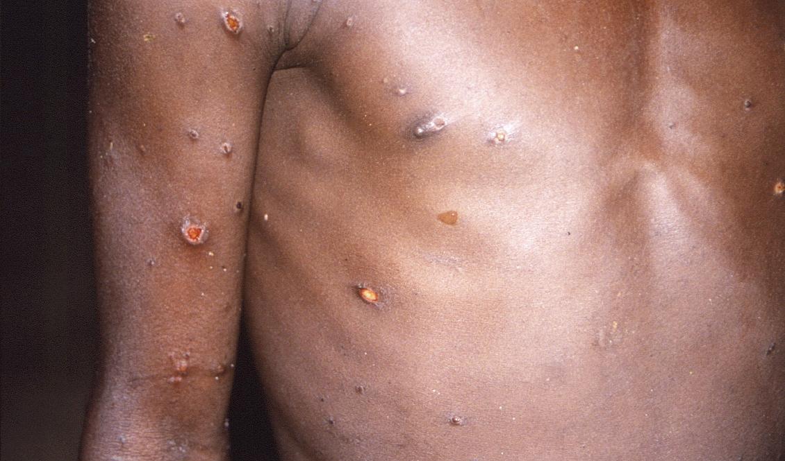 En bild på apkoppor från 1997 som distribuerats av CDC, USA:s motsvarighet till Folkhälsomyndigheten.  Foto: AP/CDC/TT