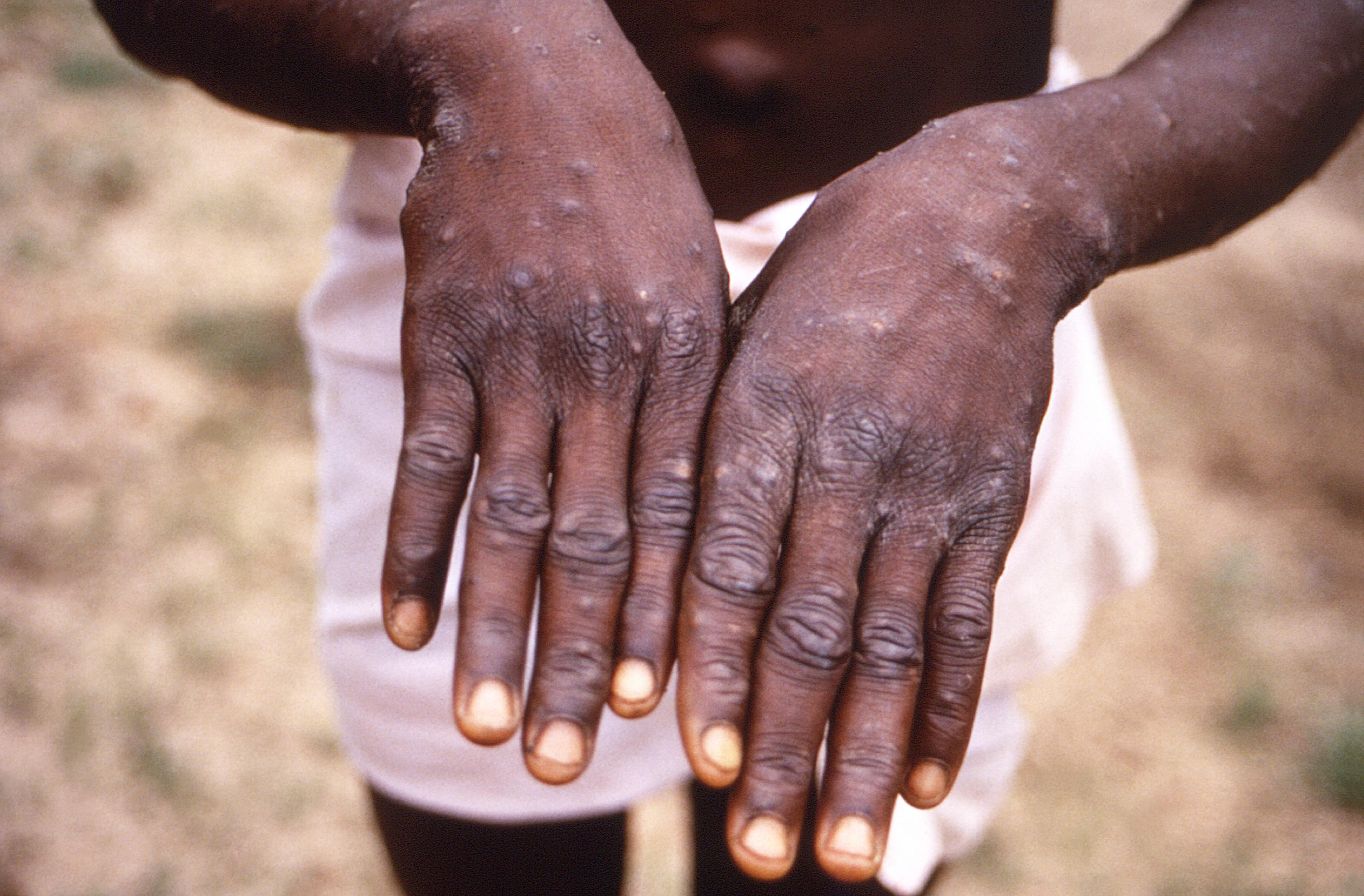 Det nya mpox-viruset sprids via hudkontakt mellan människor. Arkivbild. Foto: CDC/AP/TT