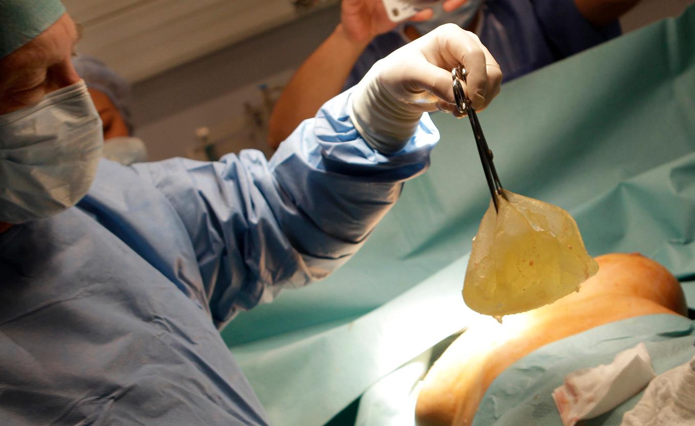 En plastikkirurg i Nice, Frankrike, opererar ut ett PIP-implantat från en patient 2012 efter att de upptäckts vara undermåliga. Foto: Lionel Cironneau/AP/TT