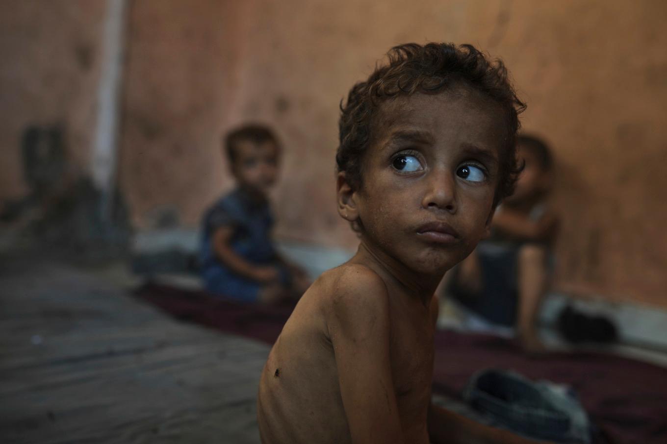 En undernärd tvåårig pojke i ett flyktingläger i Gaza stad. Foto: Jehad Alshrafi/AP/TT