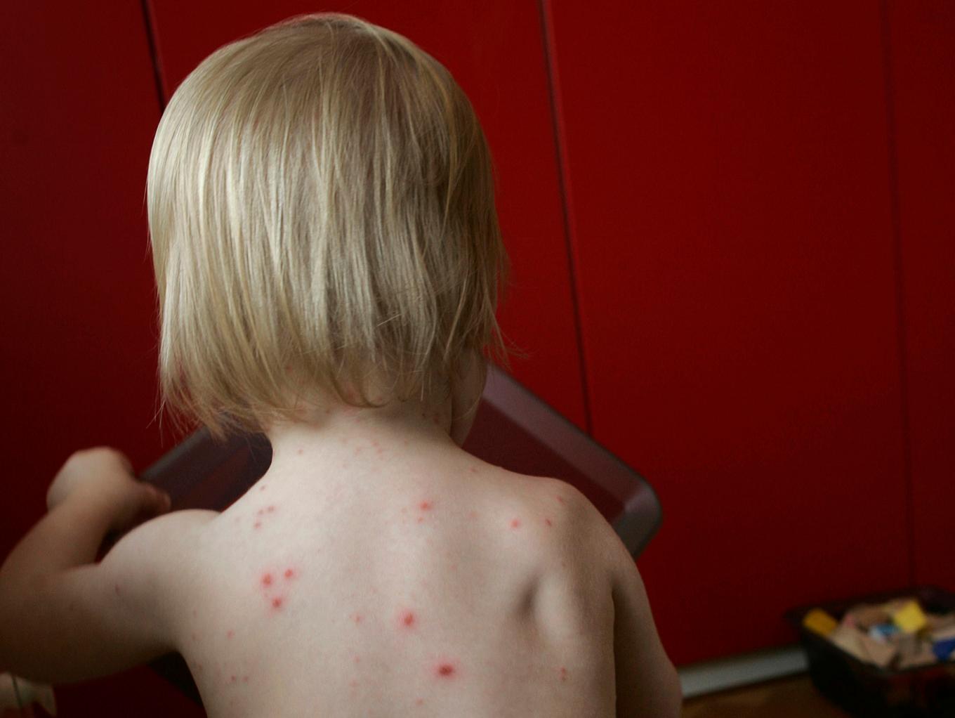 Liten pojke med kliande prickar orsakade av vattkoppor. Arkivbild. Foto: Fredrik Sandberg / TT