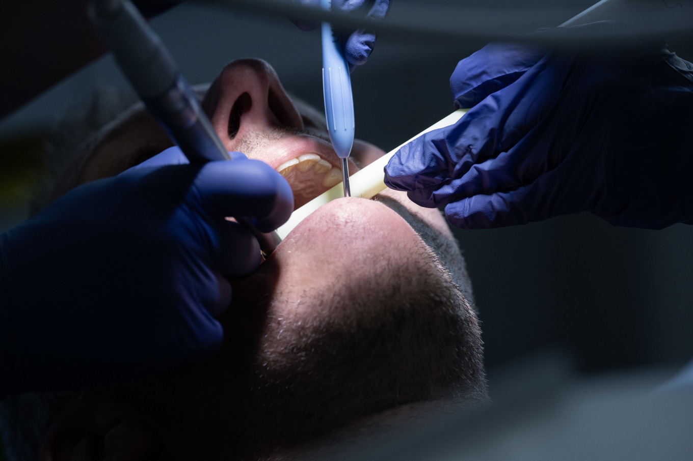 Amalgam inom tandvården är på väg att fasas ut världen över. Arkivbild. Foto: Fredrik Sandberg/TT