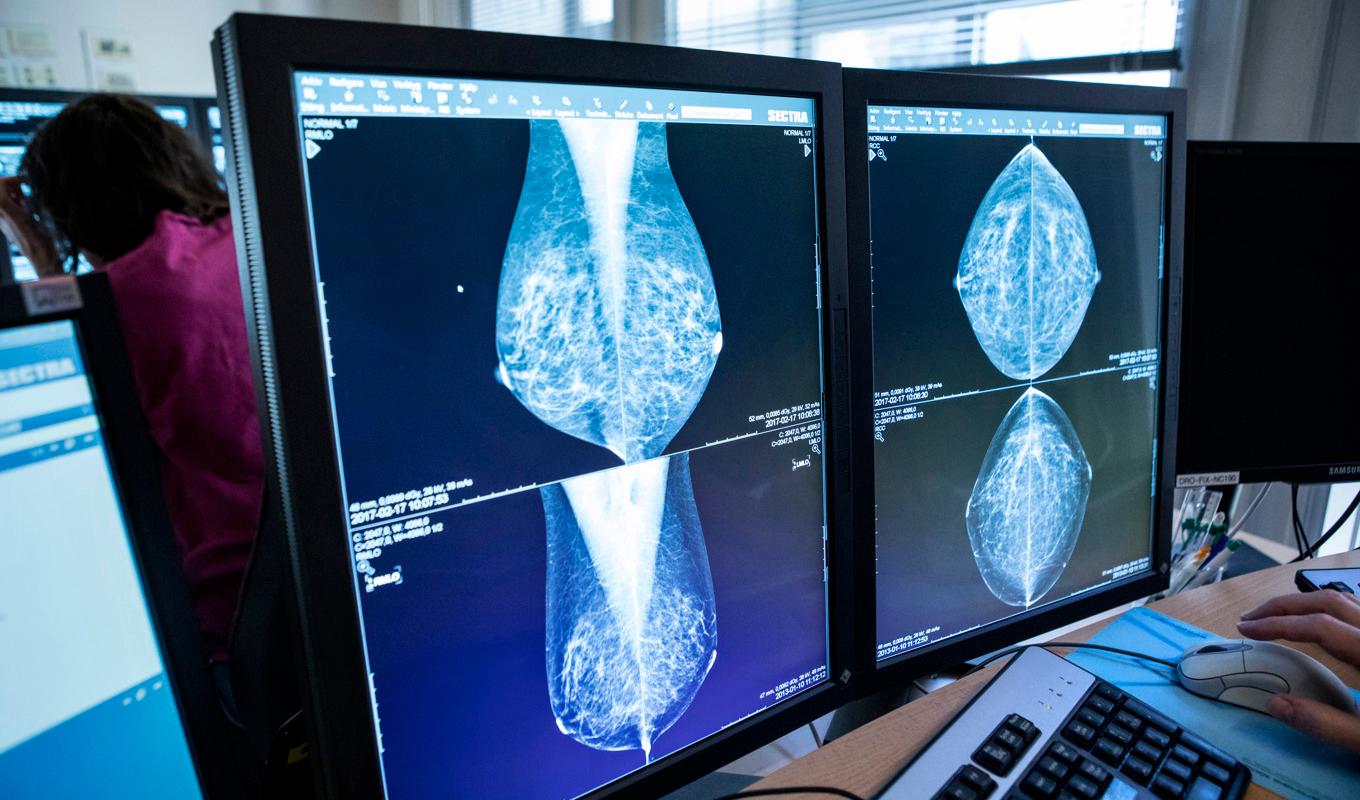 Antalet cancerfall bland personer under 50 år ökar globalt, och bröstcancer är den cancerform som skördar flest liv i den här gruppen. Här granskar en läkare mammografibilder. Arkivbild. Foto: Christine Olsson/TT