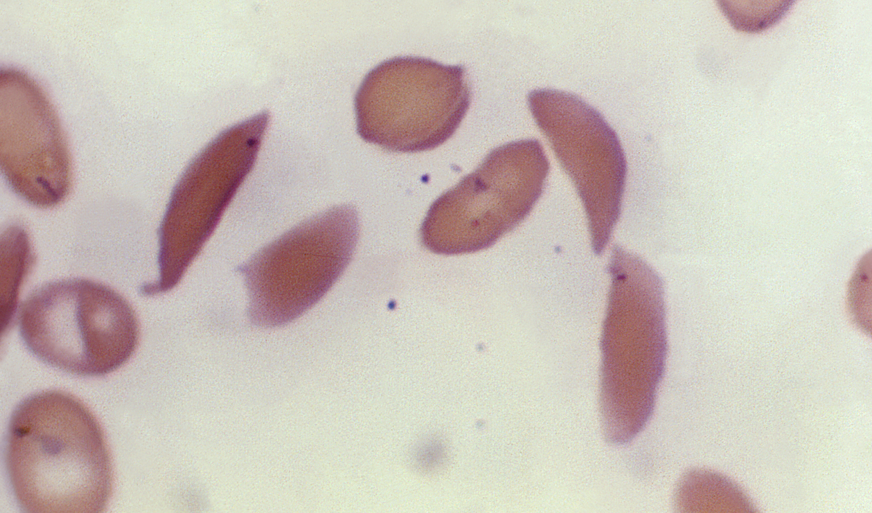 Storbritannien har som första land i världen godkänt den så kallade gensaxen för behandling av allvarliga blodsjukdomar. Arkivbild. Foto: F. Gilbert/AP/TT