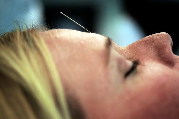 Cristi Bundukamara slappnar av under en akupunktursession vid medicinsymposiet på University Of Miami Miller School Of Medicine den 23 april 2010 i Florida, USA. (Foto: Joe Raedle/Getty Images)