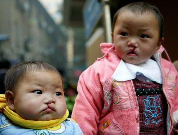 Barn med gom- och läppspalt väntar på undersökning i Nanjing Drum Tower Hospital i staden Nanjing. (China Photos/Getty Images)