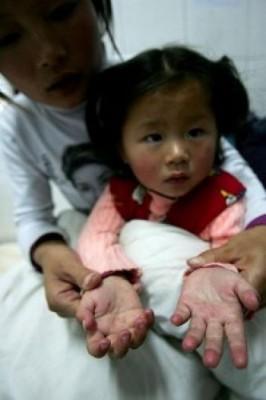 Ett barn med typiska utslag som man får av hand- fot- och munsjuka. (Foto: AFP/Getty Images)