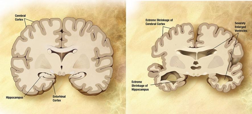 Diagrammet till höger visar en hjärna som är påverkad av Alzheimers sjukdom. Diagrammet till vänster visar en frisk hjärna. (Wikimedia Commons)
