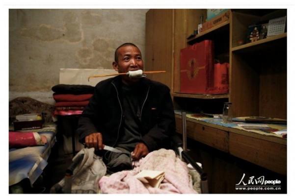 Zheng Yanliang, som amputerade sitt eget ben när smärtan från en obotlig sjukdom blev helt outhärdlig. (Skärmdump/People's Daily)
