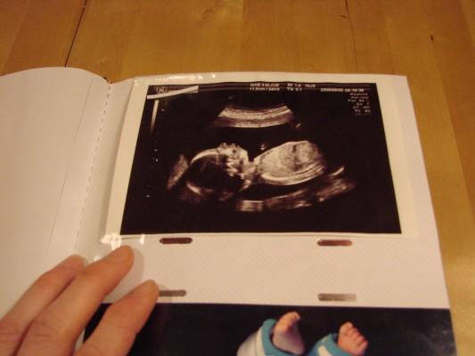 Många vill gärna ha en fin bild på fostret vid ultraljudsundersökningen, att spara och kanske att visa upp. Bilden, en 2D-bild, visar en profil av ett foster i graviditetsvecka 19. (Foto: Eva Sagerfors/Epoch Times. Ultraljudsbild: Norrlands Universitetssjukhus)