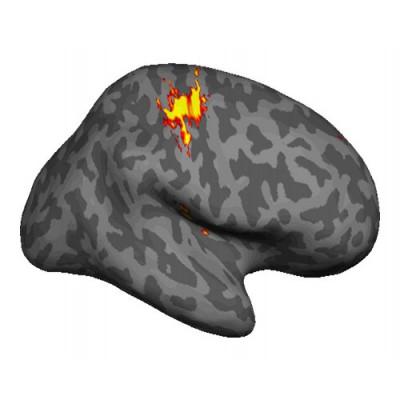 Fantomsmärta i amputerade kroppsdelar kan bero på hur pass levande hjärnan fortfarande betraktar kroppsdelen. (Foto: Oxford University)