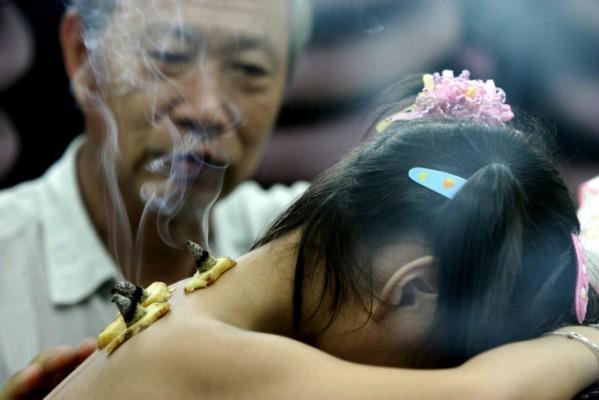 En kinesisk läkare gör en behandling med moxibustion (brinnande örter) och ingefära. (Foto: AFP Photo)