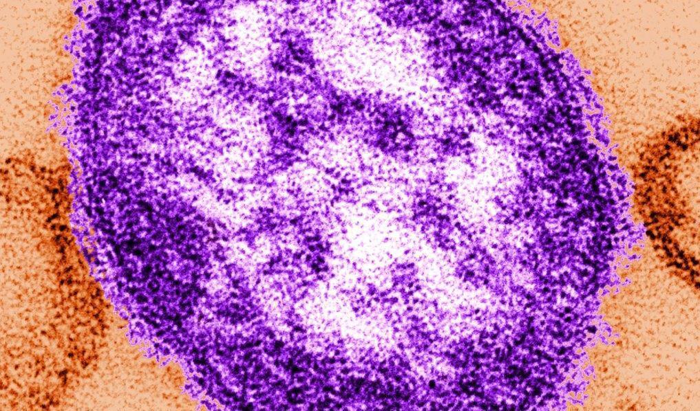 Mässling orsakas av ett extremt smittsamt virus. Foto: CDC