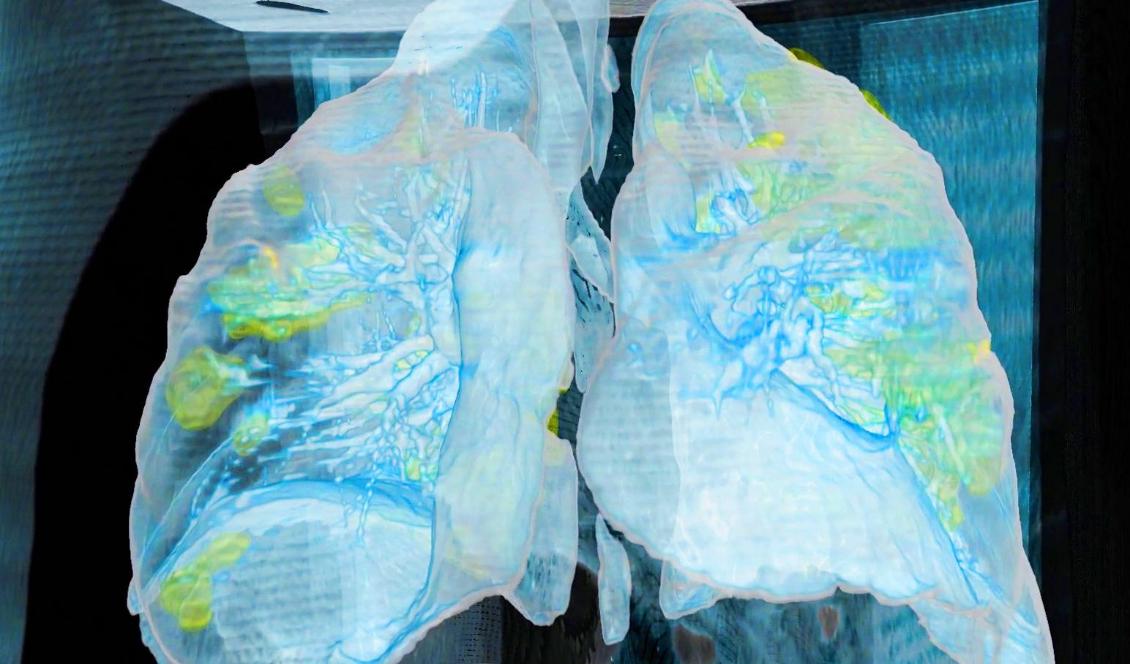 Vid covid-19 är lungorna sjukdomens "ground zero". Det är de som riskerar störst påverkan och de största skadorna. Bilden visar de omfattande lungskador (gula områden) som det nya coronaviruset kan ge upphov till. Bilden är en datortomografi av en 59-årig man som avlidit till följd av covid-19. Foto: The George Washington University Hospital