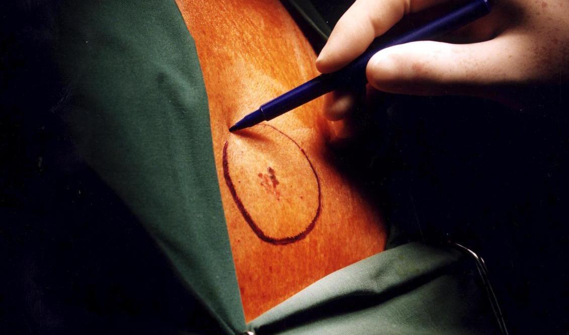 Antalet nya hudcancerfall i Sverige är nu uppe i 30 per 100|000 invånare. Arkivbild. Foto: Björn Larsson Ask/TT