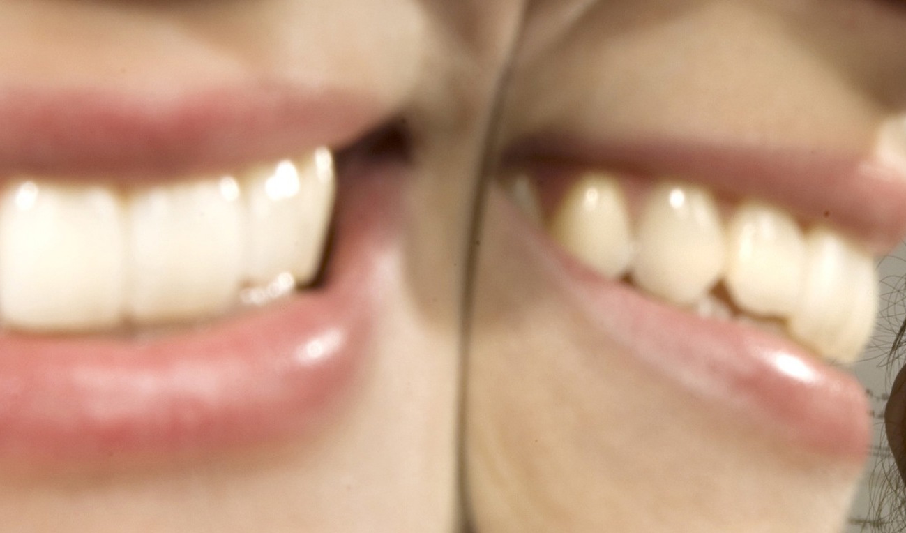 Längtan efter ett bländande leende kan vara stor. Men finns risker för den som vill bleka gaddarna. Arkivbild. Foto: Frank Gunn/AP/TT