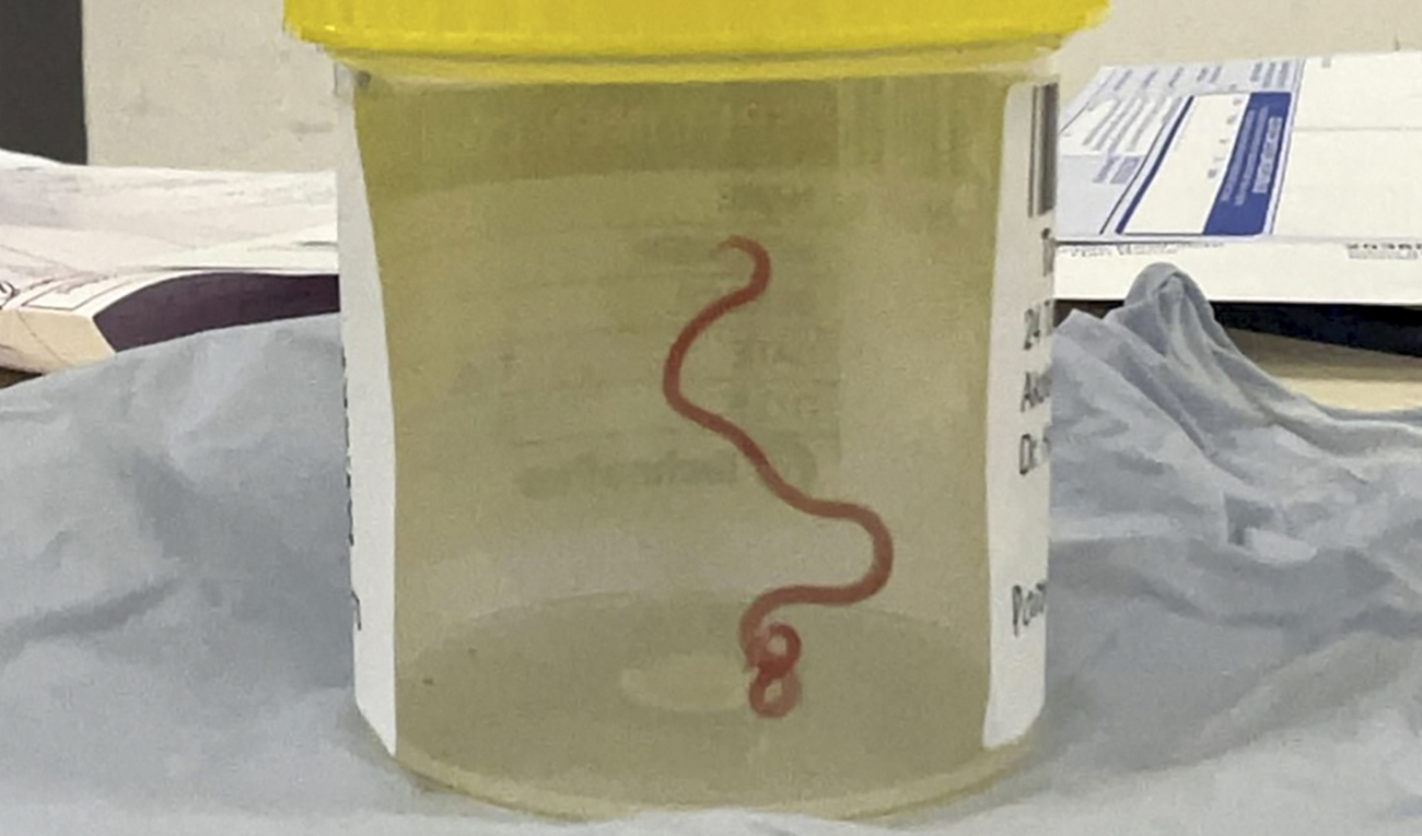 Masken fick leva tillräckligt länge för att fotograferas i en burk efter operationen. Bild från sjukhuset i Canberra. Foto: Canberras vårdmyndigheter via AP/TT