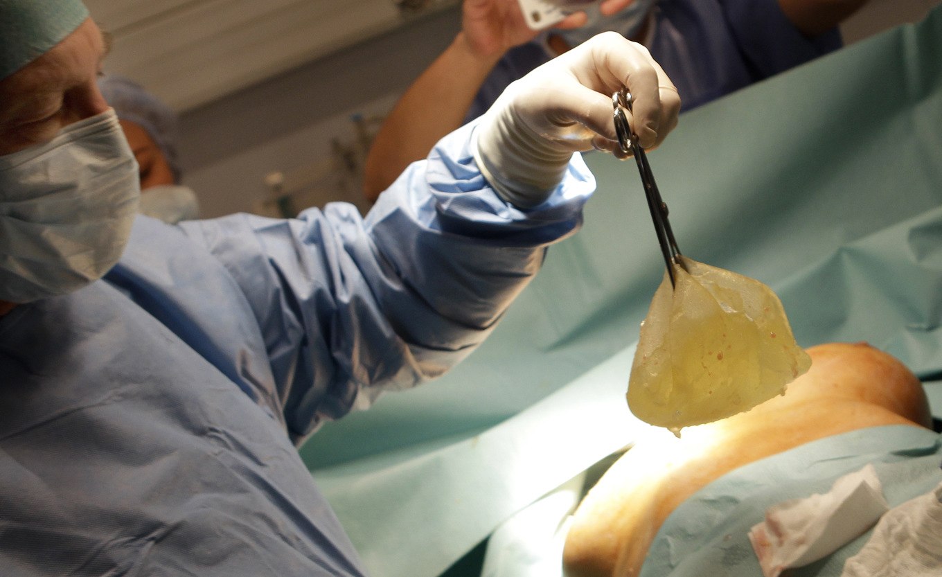 En plastikkirurg i Nice, Frankrike, opererar ut ett PIP-implantat från en patient 2012 efter att de upptäckts vara undermåliga. Foto: Lionel Cironneau/AP/TT