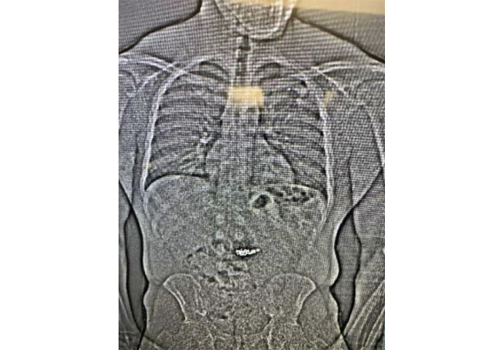 En röntgenbild som visar magen på mannen som misstänks för stöld i USA efter att ha svalt två par diamantörhängen från Tiffanys. Foto: Orlando Police Department office via AP/TT