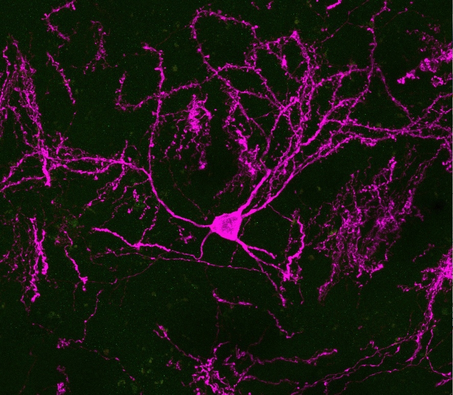 En dopaminnervcell som har mognat. Det är en sådan typ av cell som transplanterats i åtta testpersoner i en ny studie om Parkinsons sjukdom. Cellen på bilden har dock inte använts i de fallen. Foto: Parmar lab, Lunds universitet.