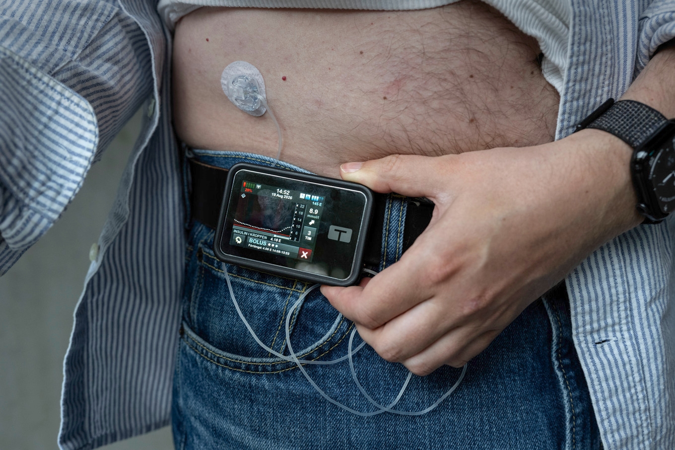 Den som har typ 1-diabetes behöver tillföra insulin, till exempel genom en automatisk pump. Nu väckts hopp om en behandling som botar sjukdomen. Arkivbild. Foto: Anders Wiklund/TT