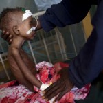 Somalia. En svårt undernärd liten flicka får behandling på ett sjukhus i Mogadishu. Somalia fortsätter att vara ett land som det är svårt att leva i, med terrorister och sjörövare. (Foto: AFP/J M Lope)
