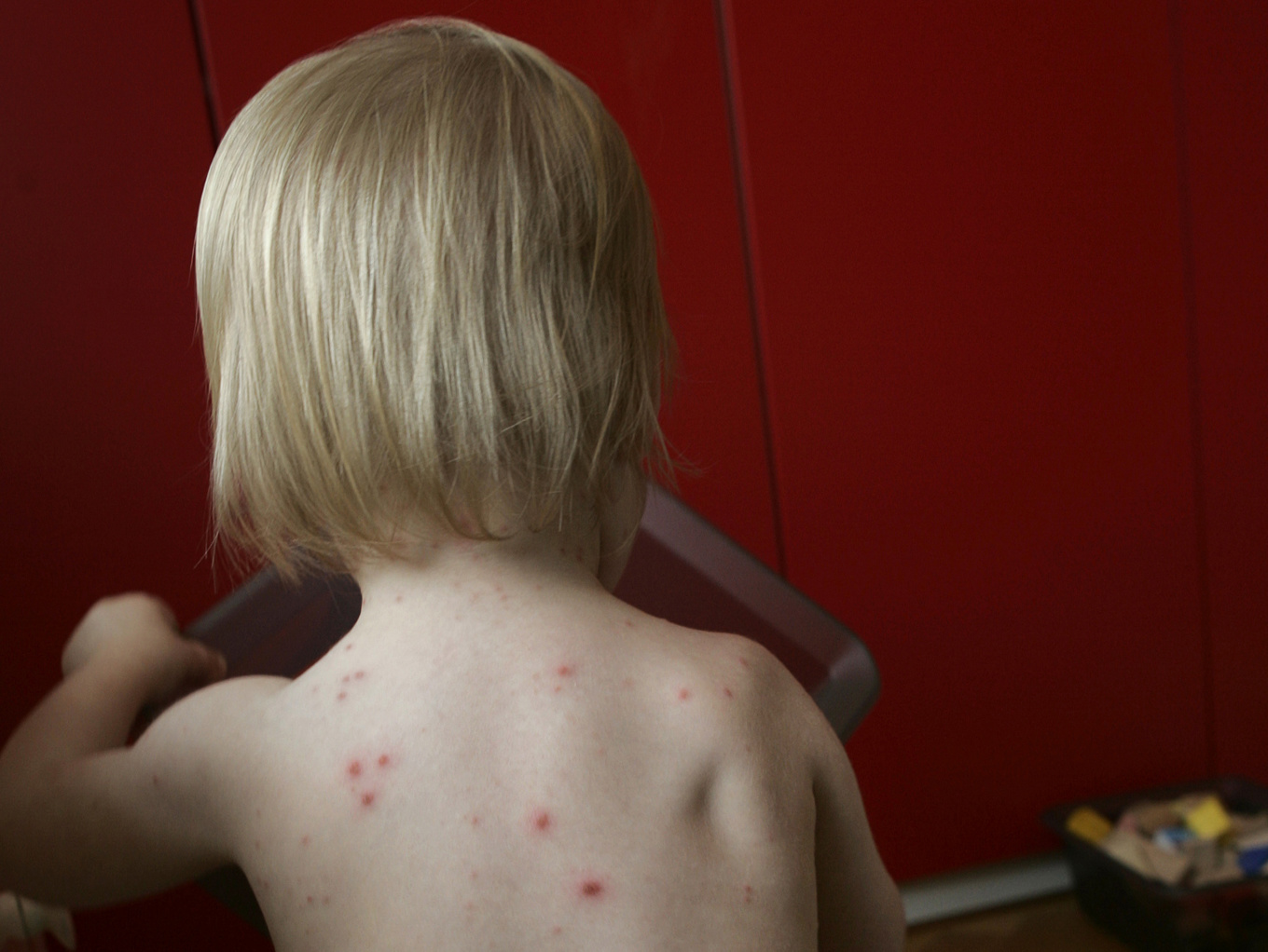 Liten pojke med kliande prickar orsakade av vattkoppor. Arkivbild. Foto: Fredrik Sandberg / TT